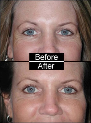 Botox for Crows Feet and Laugh Lines