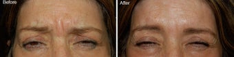 Botox treatment for brow wrinkles