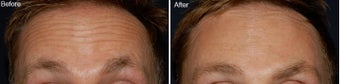 Botox for forehead lines