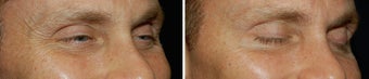 Botox for Crows Feet 