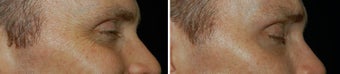 Botox for Crows Feet 