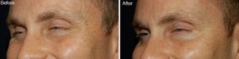 Botox for Crows Feet 