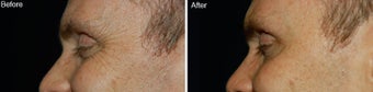 Botox for Crows Feet 