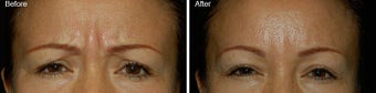 Botox for brow lines