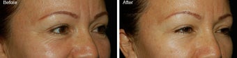 Botox for Crows Feet 