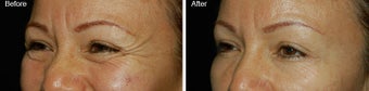 Botox for Crows Feet 