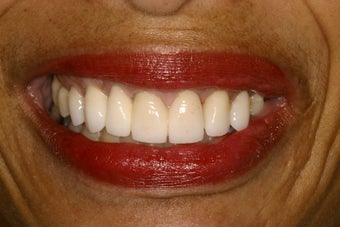 Combination Orthodontics and Porcelain Case