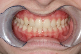 Underbite, Grummons Facemask