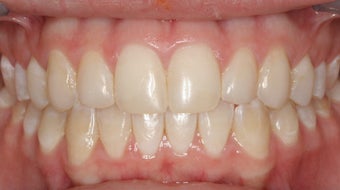 Upper Expander, Stunning Smile