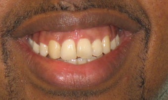 Braces: correction of openbite and dental crowding