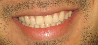 Braces used to correct crowding and bite