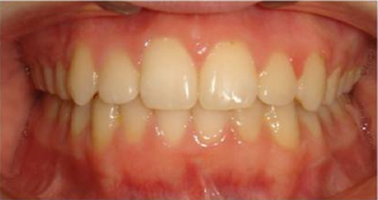 Braces in combination with orthognathic (jaw) surgery
