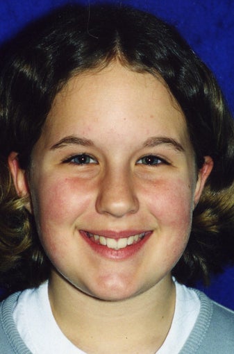 Orthodontic braces to correct a Class II malocclusion