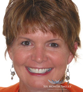 Six Month Smile/ Short term orthodontics