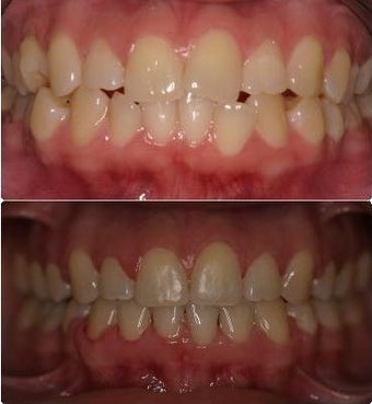 Extraction and space closure
