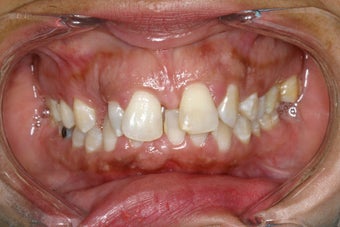 Combination Orthodontics and Porcelain Case