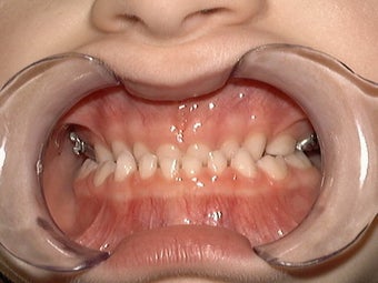 Underbite, Grummons Facemask