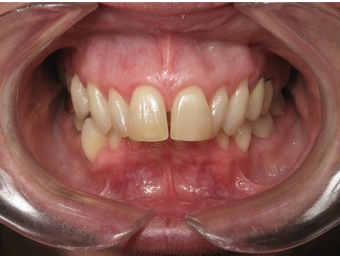 Adult Overbite, Nonextraction (braces)