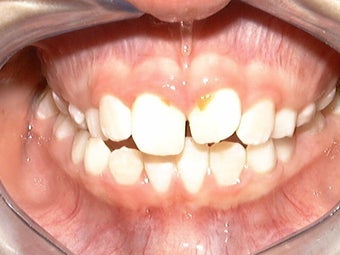 Upper Expander, Stunning Smile