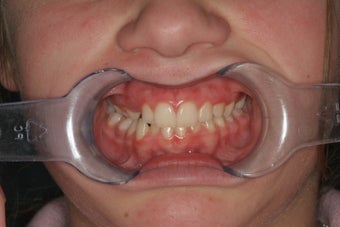 Upper Expander, Narrow Jaw, Impacted Canine