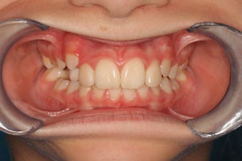 Crowding, Jaw Development