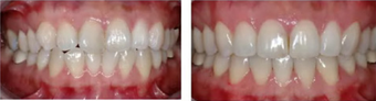 Orthodontic Braces - Crooked Teeth 