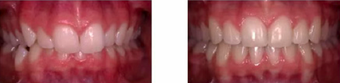 Over-bite corrected with braces