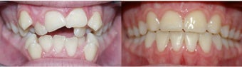 Before and after orthodontic treatment