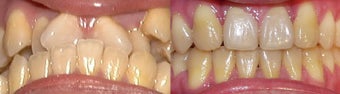 orthodontic treatment