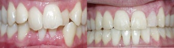 Before and after orthodontic treatment