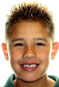 Two-Phase Orthodontic Treatment