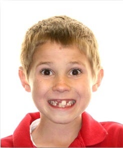 Early Orthodontic Treatment