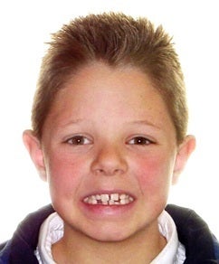 Close Spaces Between Teeth