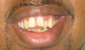Braces: correction of openbite and dental crowding