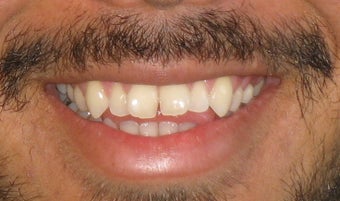 Braces used to correct crowding and bite