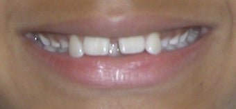 Braces to correct spacing, overbite