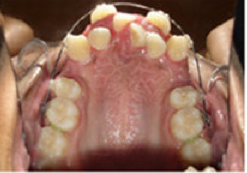 Braces and Extraction