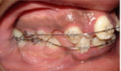 Braces and Extraction