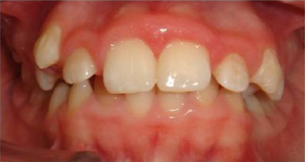 Braces in combination with orthognathic (jaw) surgery