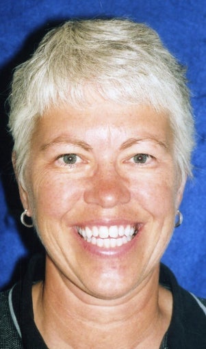Orthodontic braces with miniscrew support to close openbite