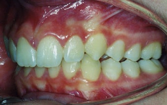 Orthodontic braces to correct a Class II malocclusion