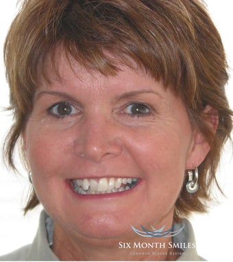 Six Month Smile/ Short term orthodontics