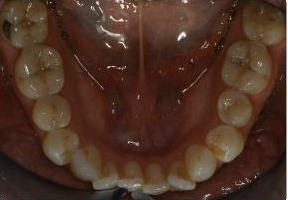 Orthodontic treatment without extraction of teeth