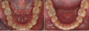 Extraction and space closure