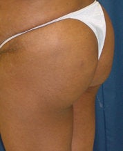Brazilian Butt Lift 