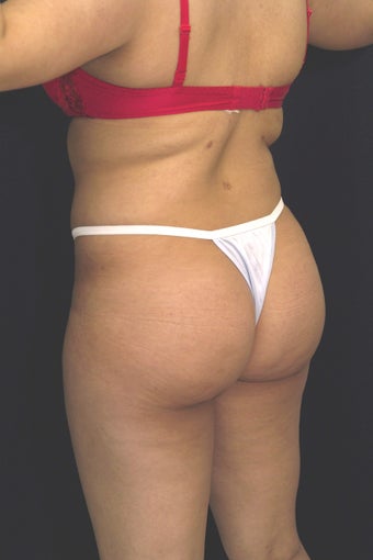 Fat injections to buttocks for Brazilian Butt Lift