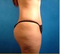Brazilian Buttock Lift
