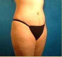 Brazilian Buttock Lift
