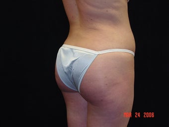Brazilian Buttocks Lift 