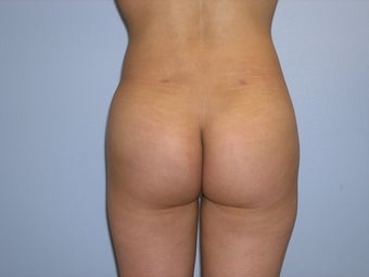 Brazilian buttock augmentation